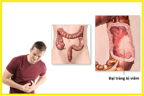 Điều trị viêm đại tràng mãn tính - Giải pháp nào hiệu quả và an toàn nhất?