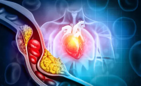 Mỡ máu và tiểu đường: Bộ đôi sát thủ đe dọa tính mạng
