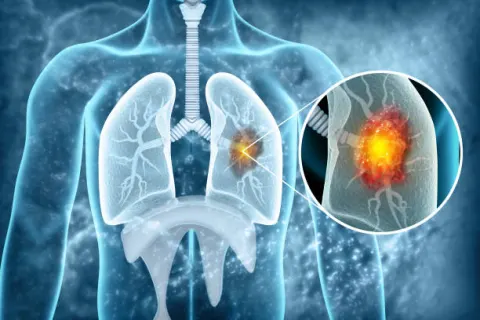Nhiễm độc phổi là nguyên nhân hình thành bệnh COPD