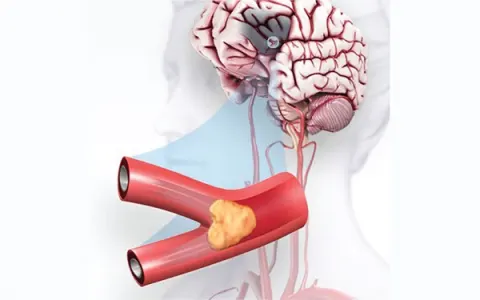 Nhồi máu não: Nguyên nhân, triệu chứng, cách điều trị và phòng ngừa