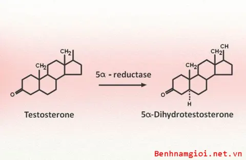Sự tăng tiết Enzyme 5-alpha reductase chính là nguyên nhân gây u xơ tiền liệt tuyến