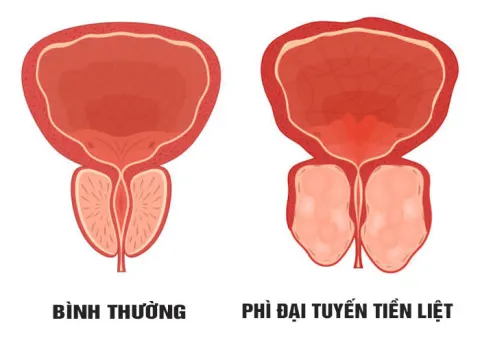 Tuyến tiền liệt bình thường và tuyến tiền liệt bị phì đại