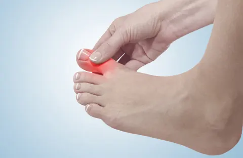  Cơn đau gút cấp thường khởi phát ở ngón chân cái