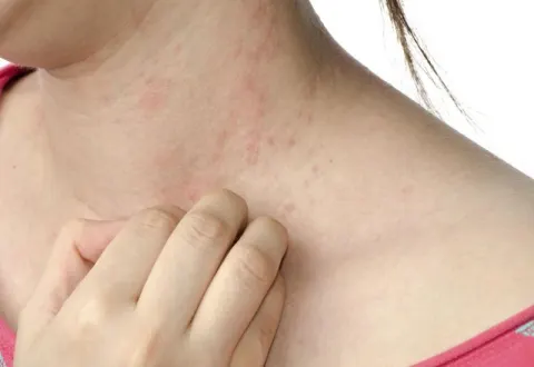 Mùa hè dễ gây dị ứng da dẫn đến mất ngủ