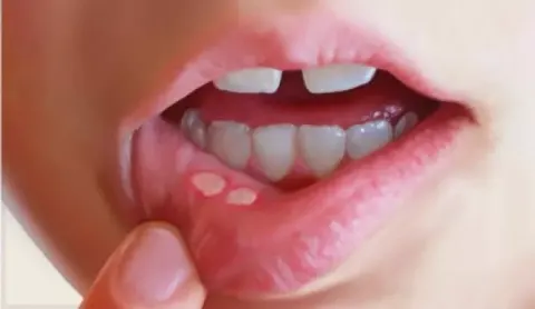 Nhiệt miệng là gì? Cách điều trị nhiệt miệng tại nhà hiệu quả