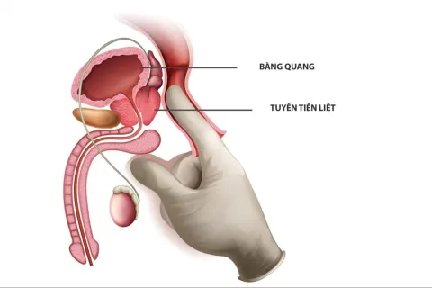 Thăm khám trực tràng