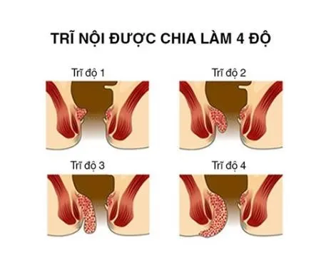 BoniVein cải thiện bệnh trĩ như thế nào?