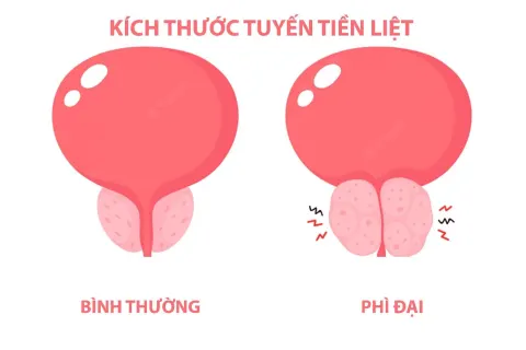 Kích thước tiền liệt tuyến bình thường là bao nhiêu, khi bị phì đại là bao nhiêu?