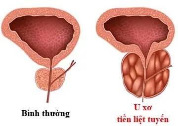 BoniMen – Bí quyết ngăn ngừa sự phát triển của u xơ phì đại tuyến tiền liệt từ Canada