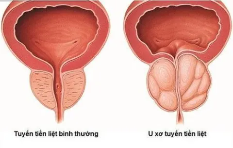 Tìm hiểu 3 giai đoạn phát triển của bệnh u xơ tuyến tiền liệt