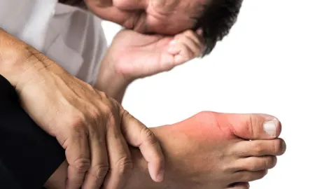 Người bị bệnh gút có uống glucosamin được không?