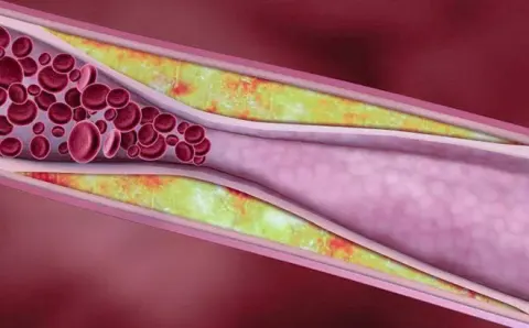 Tăng đường huyết và kháng insulin khiến các mảng xơ vữa dễ hình thành