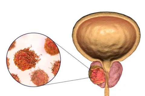 Ung thư tuyến tiền liệt