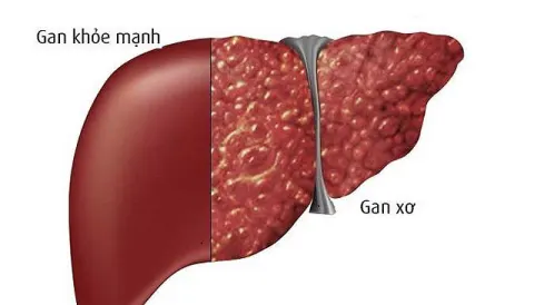 Gan bị xơ và gan khỏe mạnh
