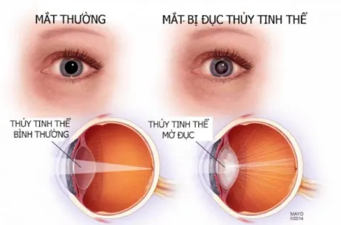 Đục thủy tinh thể là nguyên nhân gây mờ mắt