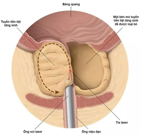     Mổ nội soi tuyến tiền liệt bằng laser gây ra nhiều tác dụng phụ