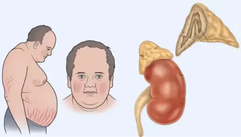 Những gì người mắc hội chứng Cushing cần biết để cải thiện bệnh hiệu quả