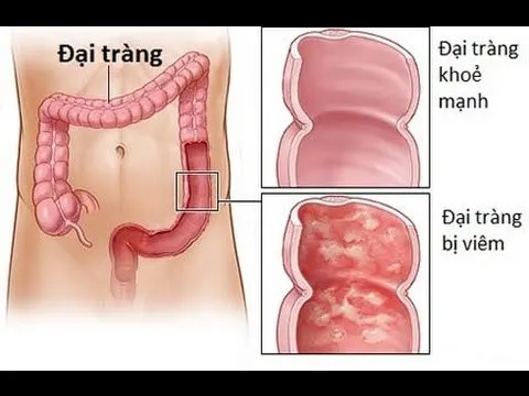 Thường xuyên bị táo bón, tiêu chảy xen kẽ, phân lẫn nhầy và máu?