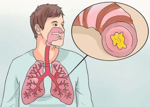 Viêm phế quản mạn tính là gì? Làm sao để cải thiện bệnh tốt nhất?