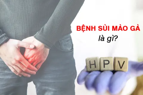 Bệnh sùi mào gà là gì? Dấu hiệu, triệu chứng, cách điều trị và phòng tránh