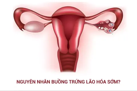 Nguyên nhân buồng trứng lão hóa sớm và cách cải thiện