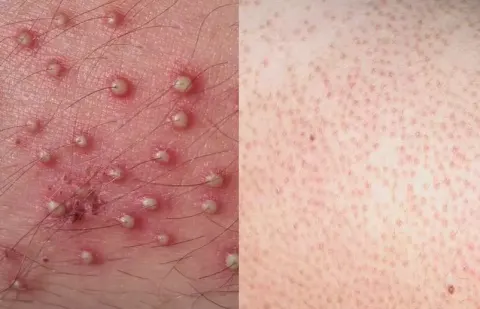 Phân biệt, cách điều trị viêm nang lông và dày sừng nang lông