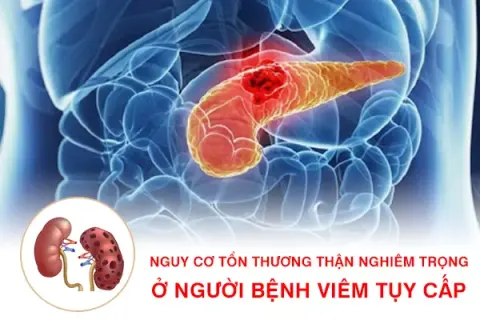 Cảnh báo nguy cơ tổn thương thận nghiêm trọng ở người bệnh viêm tụy cấp