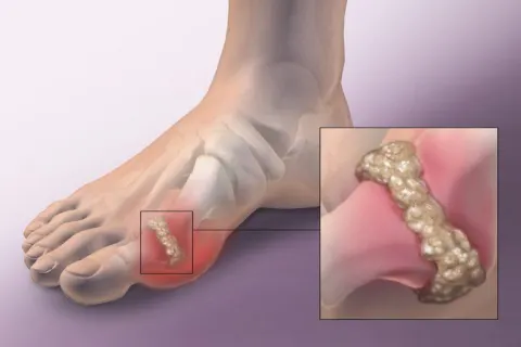 Hạt tophi tích tụ tại các khớp.