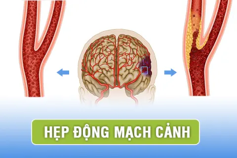 Những biến chứng nguy hiểm do hẹp động mạch cảnh và cách điều trị
