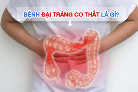 Bệnh đại tràng co thắt là gì?
