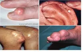 Thận trọng với những biến chứng nguy hiểm của bệnh gút
