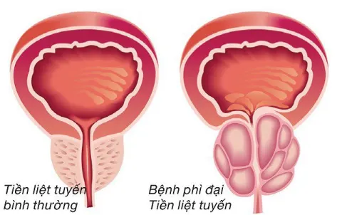 Ở người bệnh phì đại tuyến tiền liệt, kích thước tuyến này sẽ tăng lên trên 30g