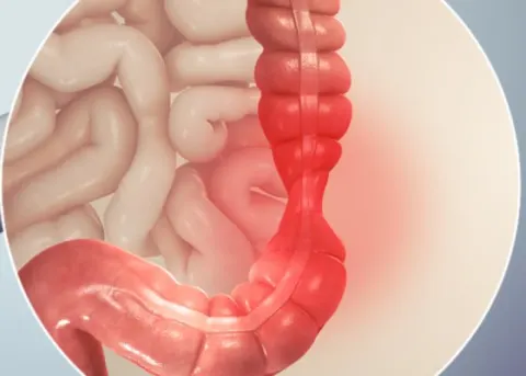Tăng co bóp, dễ bị kích thích là đặc điểm của hội chứng ruột kích thích