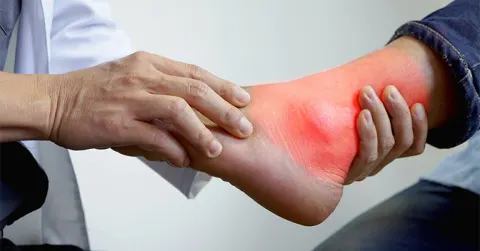 Giải pháp nào giúp kiểm soát bệnh gút không gây hại gan và suy thận?