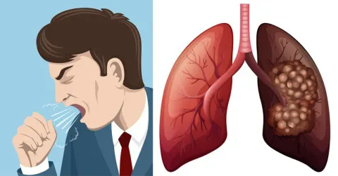 Hút thuốc lá gây ung thư phổi
