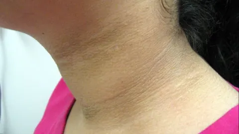 Bệnh gai đen ở người bệnh tiểu đường