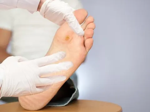 Khám bàn chân tiểu đường - Không thể coi thường!