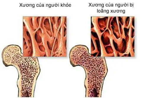 Thuốc lá có thể gây loãng xương.