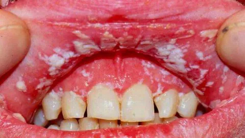 Nấm Candida khoang miệng.