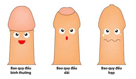 Cắt bao quy đầu thường được thực hiện khi bao quy đầu hẹp hoặc bị dài
