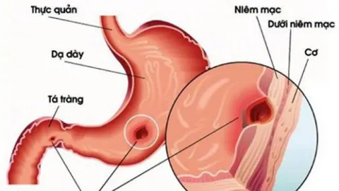 Khi say rượu nôn ra mật vàng, người uống rượu sẽ có nguy cơ gặp tình trạng viêm niêm mạc dạ dày