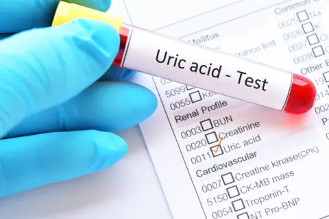 Bệnh gút gây tăng acid uric trong máu