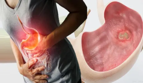 Loét dạ dày tá tràng là bệnh gì? Nguyên nhân và cách điều trị