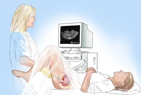 Siêu âm đầu dò là gì? Khi nào cần siêu âm đầu dò?