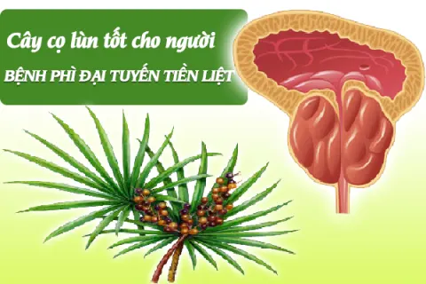Cây cọ lùn tốt cho người bệnh phì đại tuyến tiền liệt