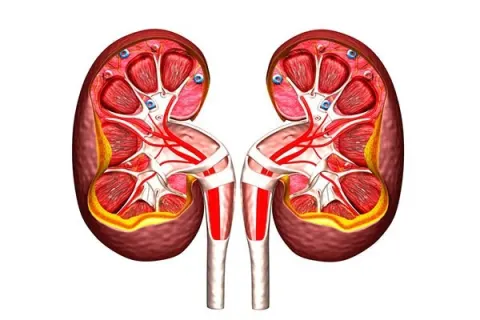 Bị gút biến chứng sang suy thận độ 1 dùng BoniGut có hiệu quả?