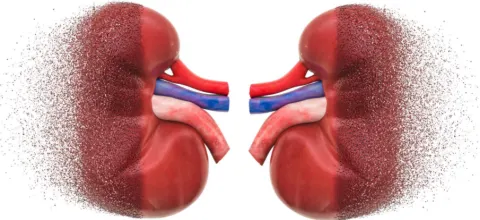 Bệnh gút gây hủy hoại thận