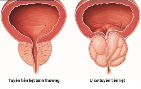 U xơ tuyến tiền liệt có mấy giai đoạn?