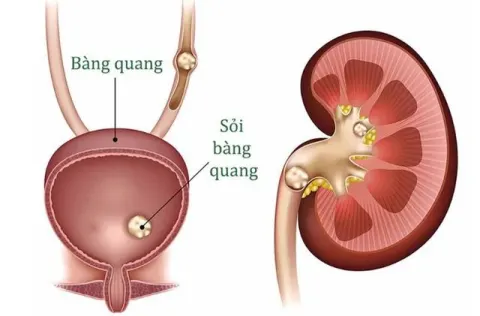 Bệnh nhân phì đại tiền liệt tuyến dễ bị sỏi bàng quang