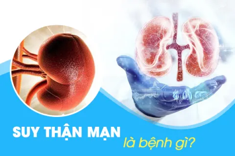 Suy thận mạn là bệnh gì? Nguyên nhân, triệu chứng và cách điều trị